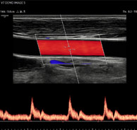 écran de controle echographie cardiaque