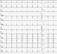 tracé electrocardiogramme